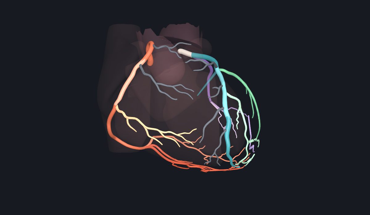 Corazón en tres dimensiones con las arterias coronarias coloreadas por segmento de la SCCT 2026: coronaria derecha, tronco común izquierdo, descendente anterior, circunfleja y sus ramas, en una anatomía con dominancia derecha.